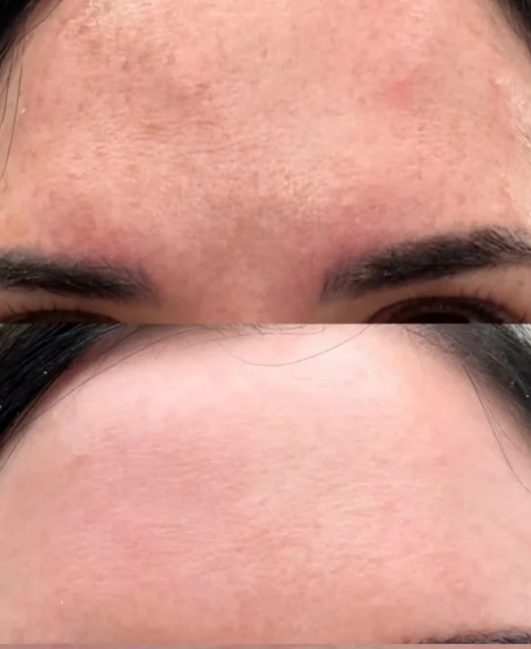 Best Treatments for pigmentation Basingstoke. Chemical peel results