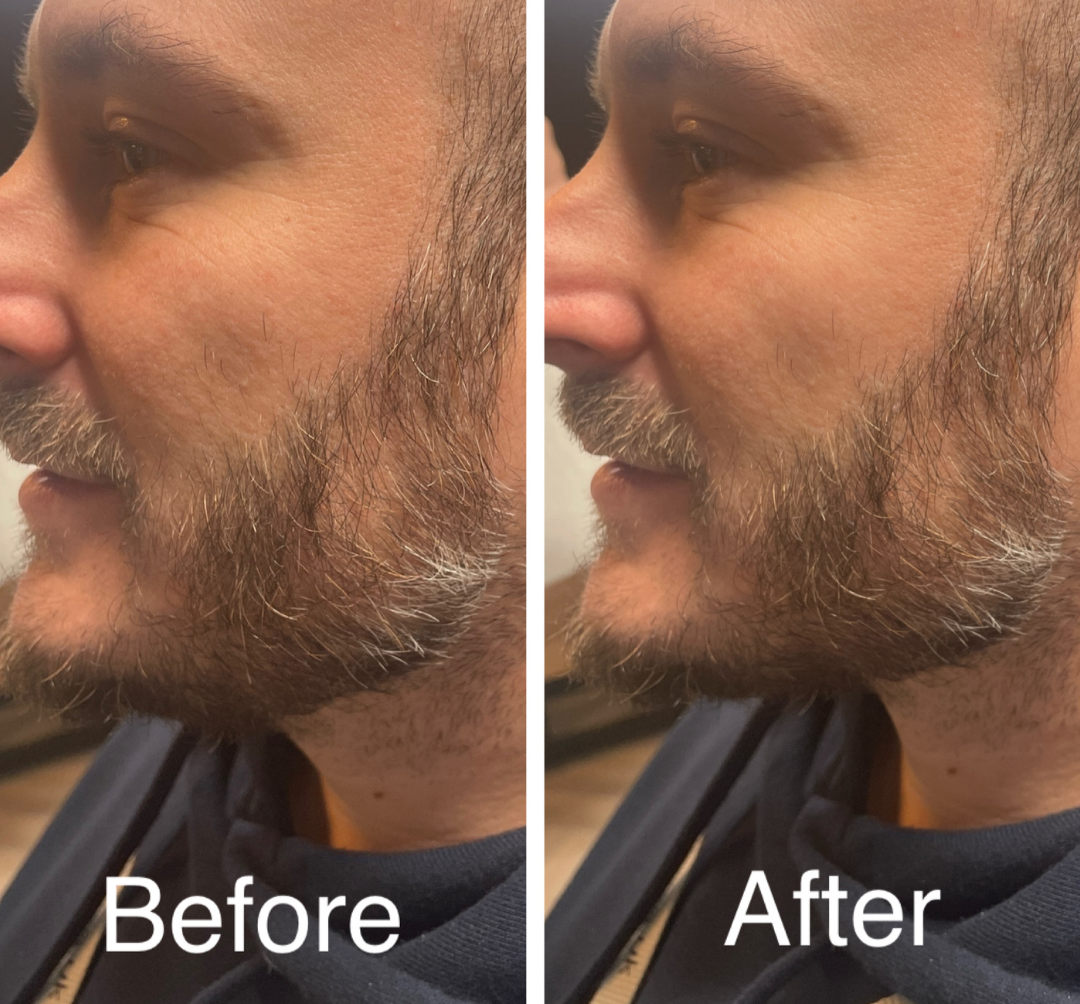 chin and jawline filler for male clients in Basingstoke