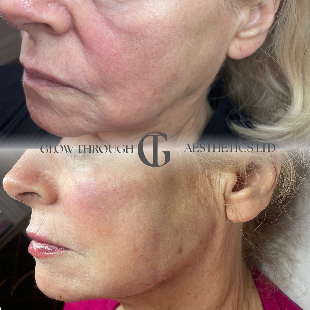 post weight loss cheek restoration using filler