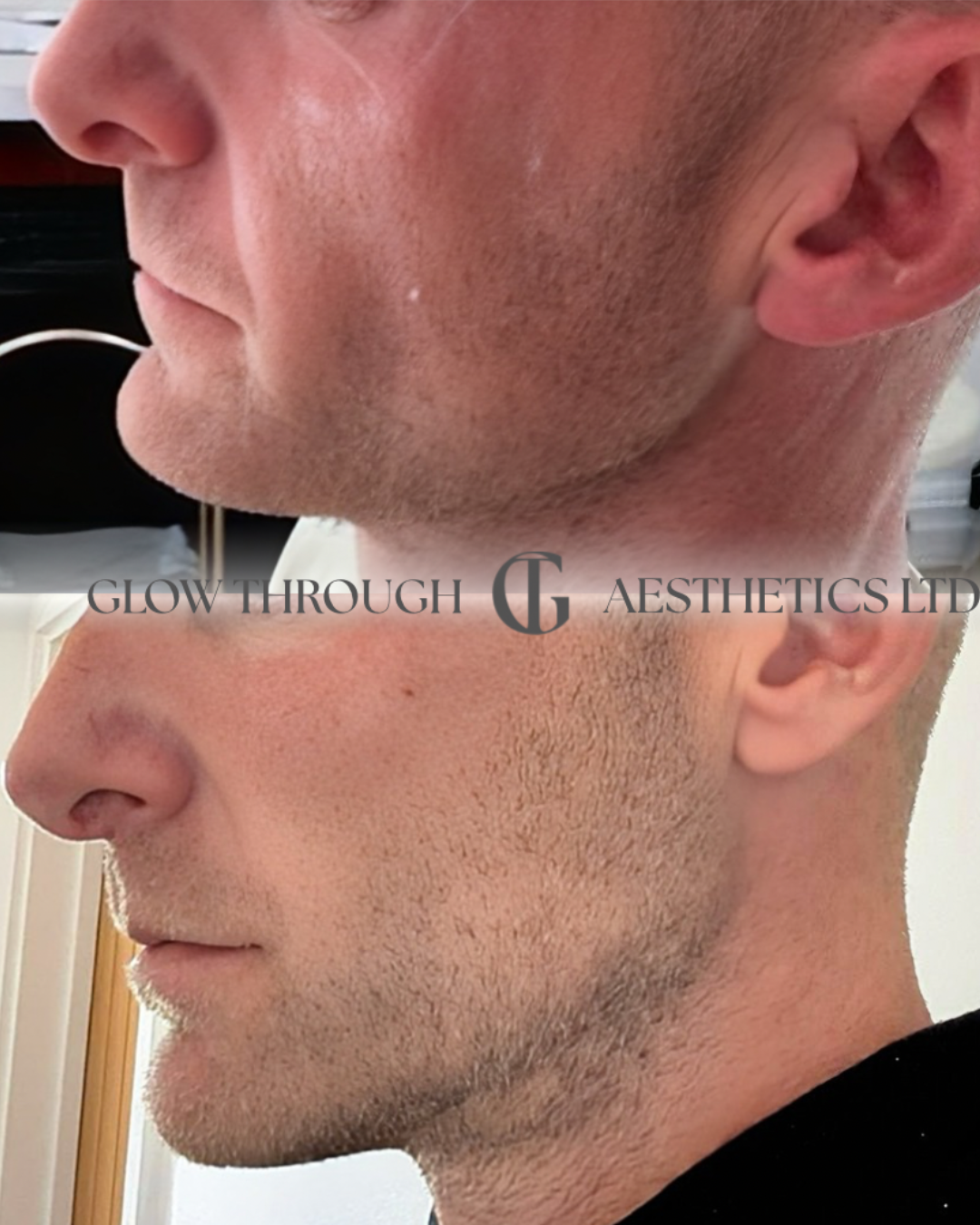 cheek and jawline filler for male clinets in Basingstoke
