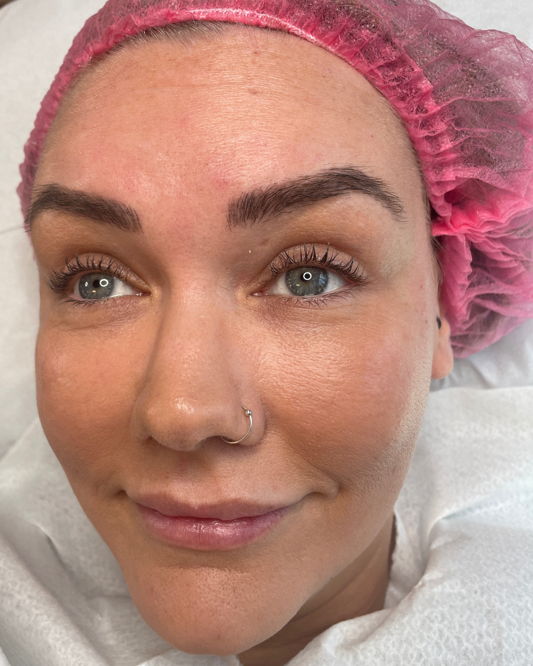 Cheek filler & 3 areas in Basingstoke. Glow Through Aesthetics Basingstoke Town Centre