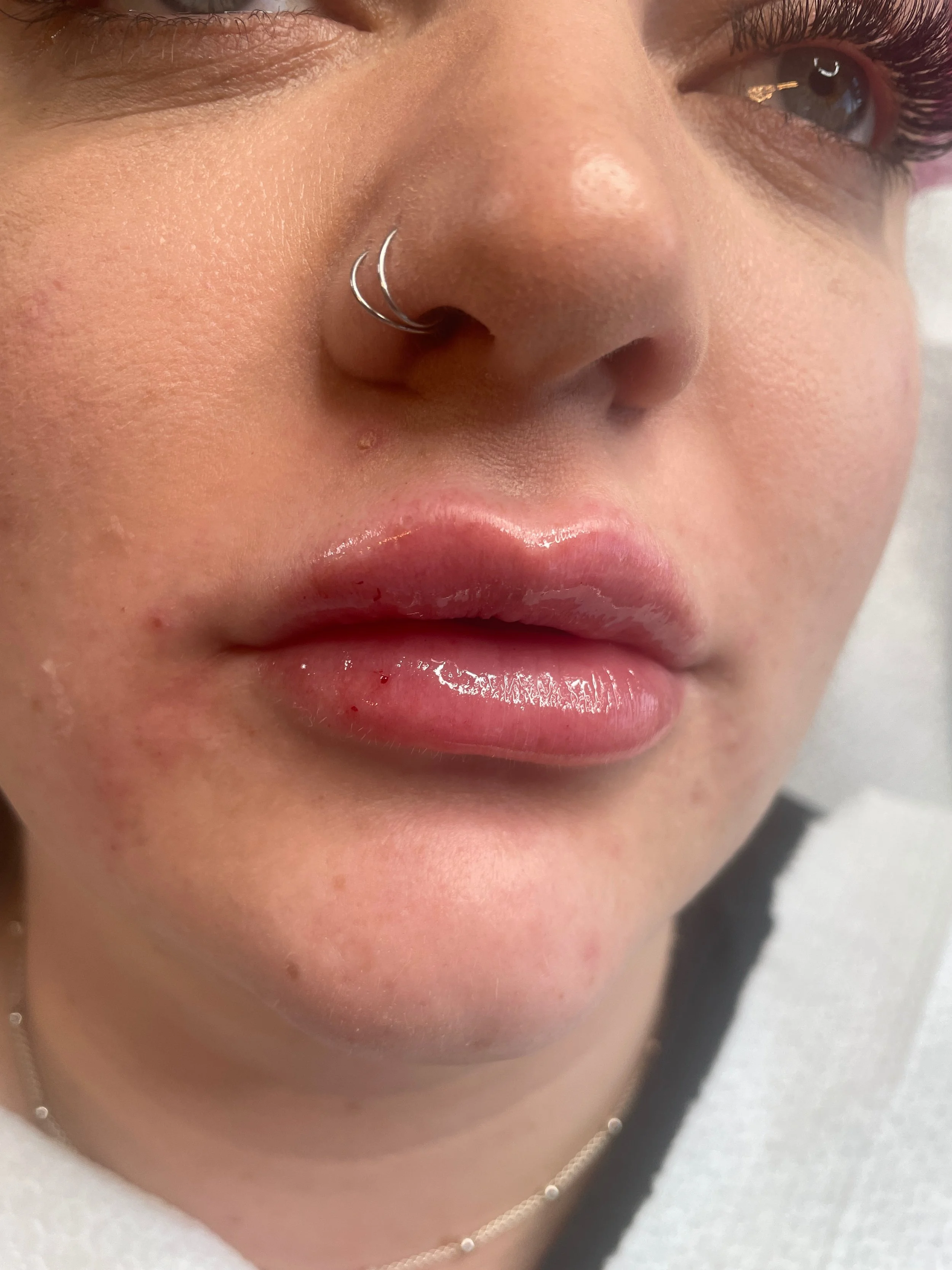 lip filler at our Basingstoke Clinic