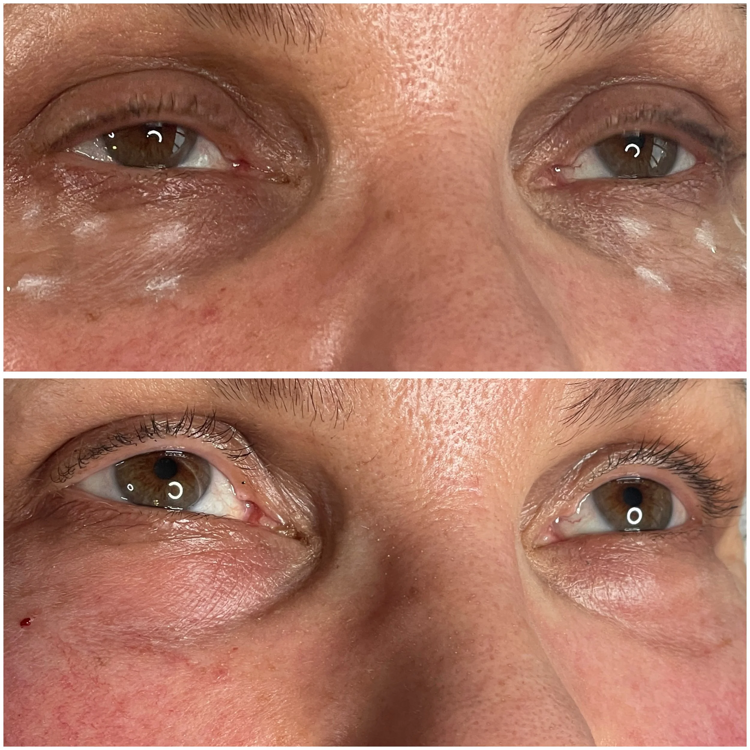 sunekos eye boosters in Basingstoke. Lumi eye results in Hampshire clinic, Glow Through Aesthetics
