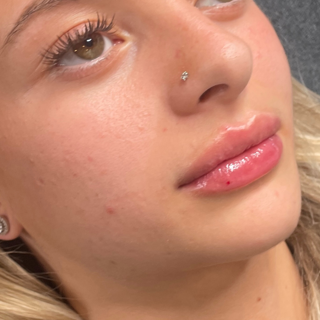 lip filler results at Glow Through Aesthetics Basingstoke