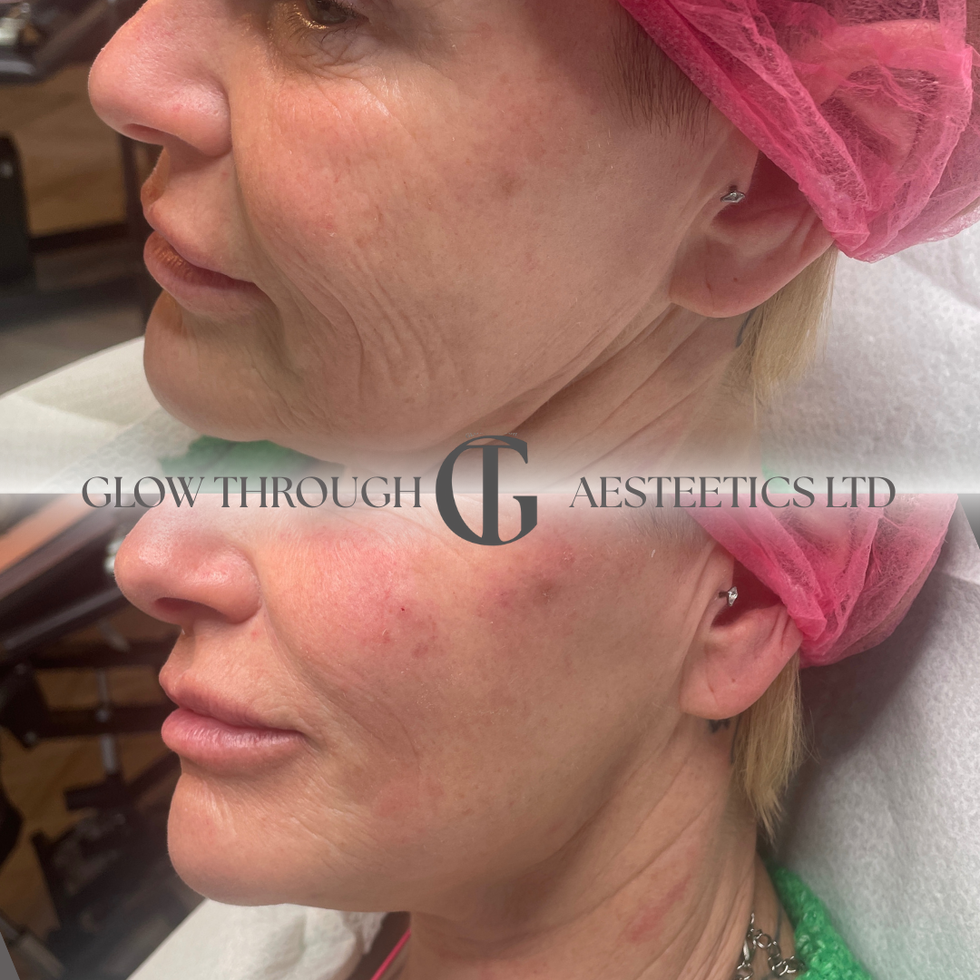 Signature refresh using fillers and polynucleotides at our Basingstoke clinic