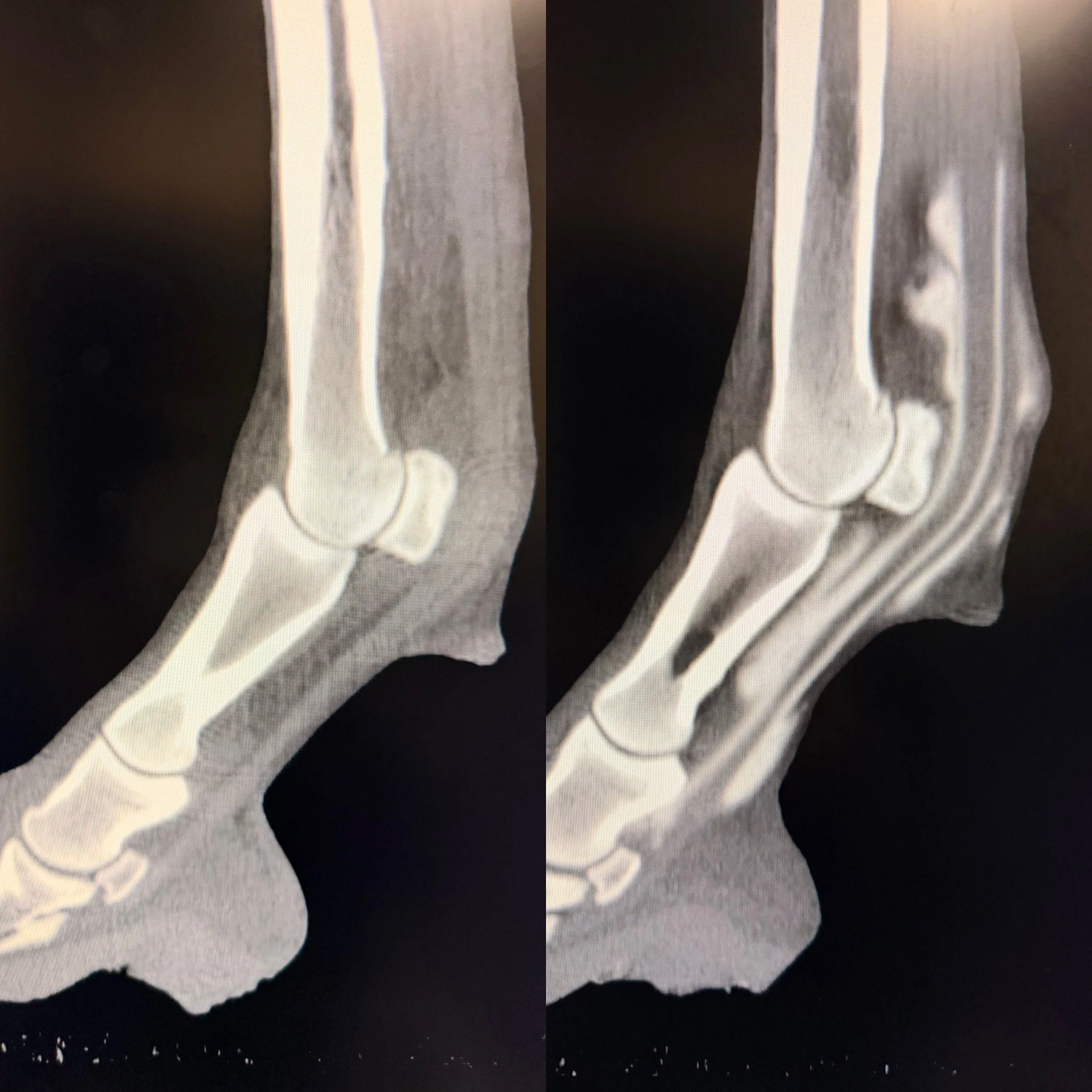 X-ray images of a human ankle and foot, showing the bones and joints in side and front views.