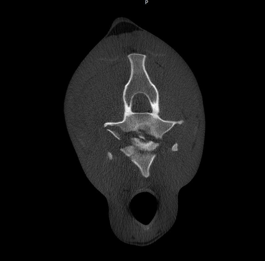 Cross-sectional medical scan image of a human spine viewed from below