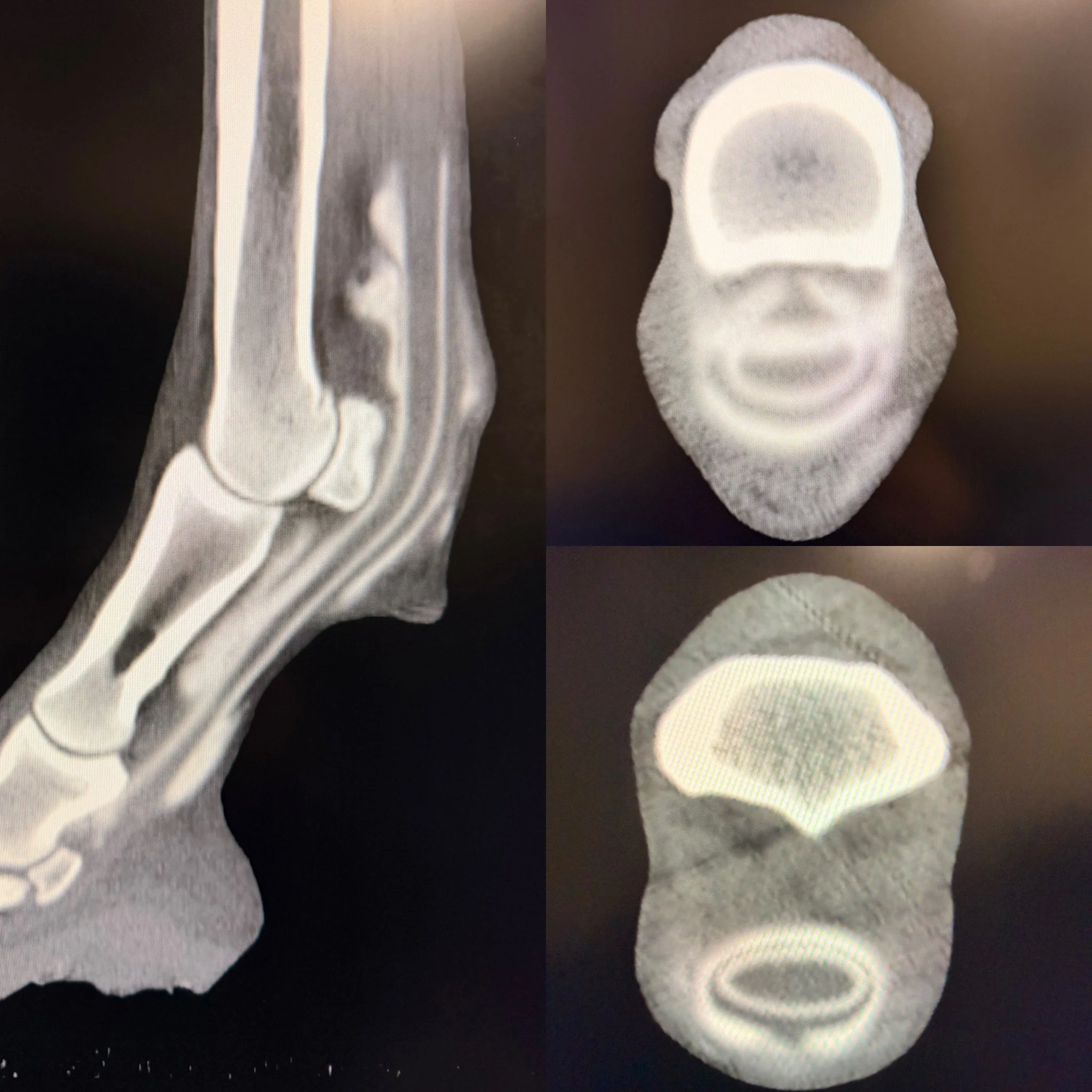 CT scan of a human ankle in lateral view, with cross-sectional images of the ankle's bones from above and below.