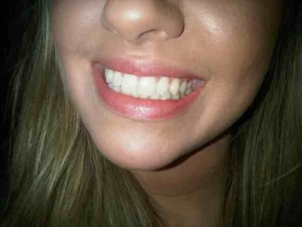 A mouth makeover: Carbamide Teeth Whitening. 