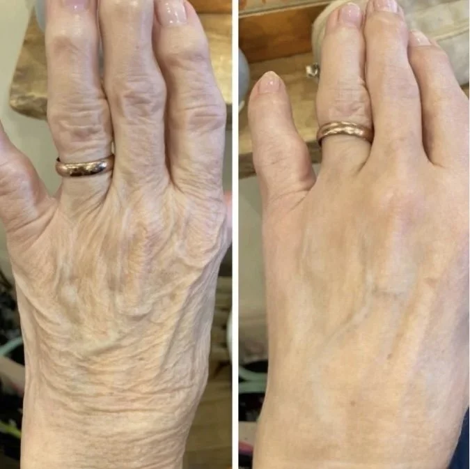 RADIESSE HAND REJUVENATION