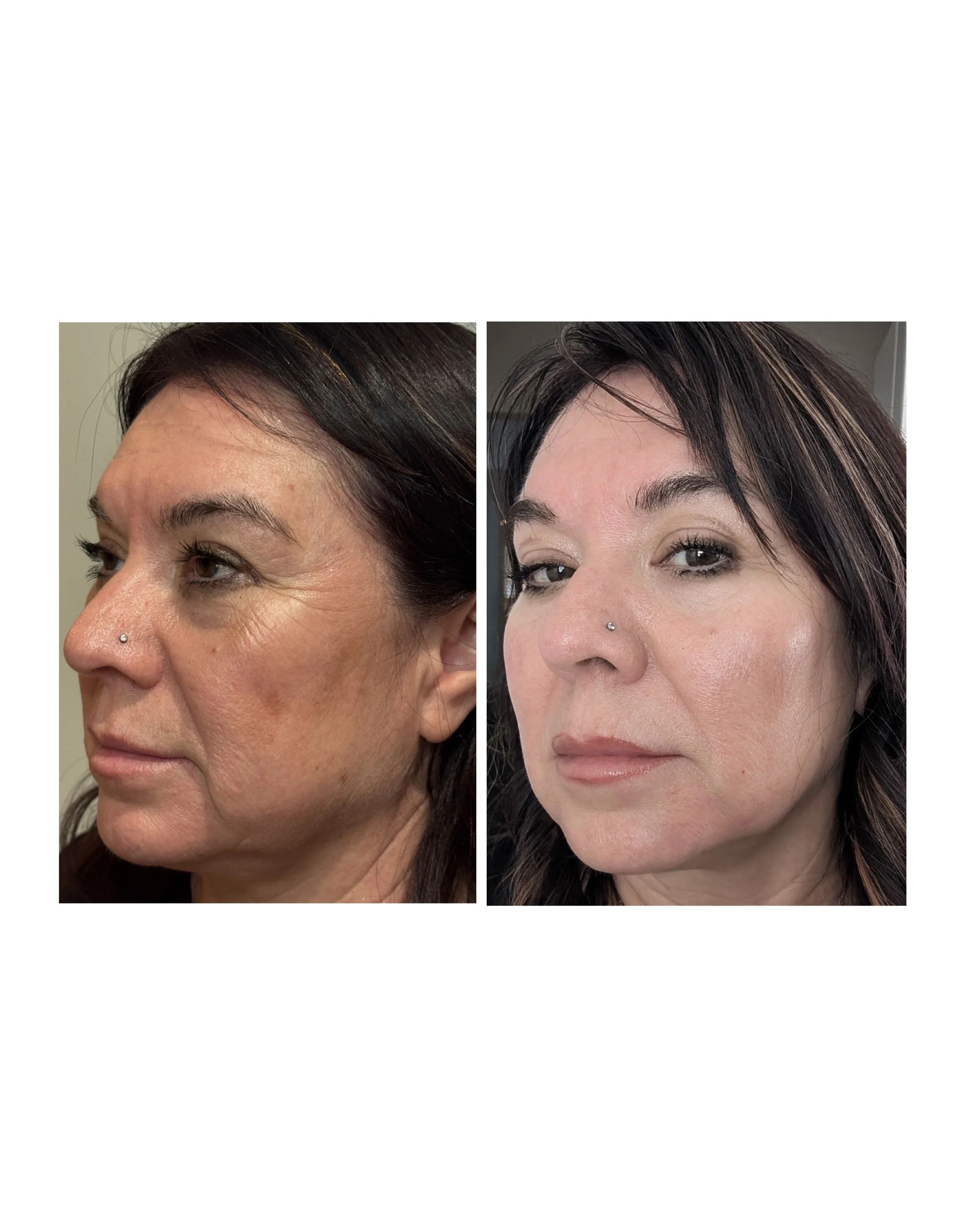 RADIESSE FACIAL REJUVENATION