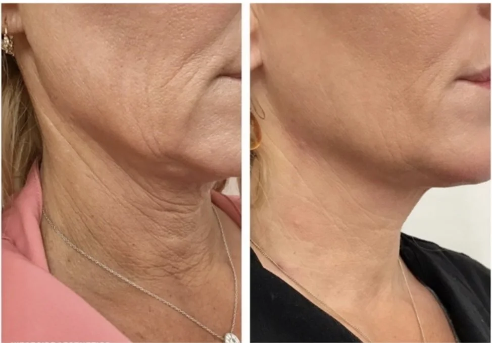 RADIESSE NECK REJUVENATION