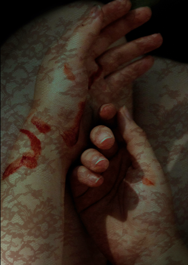Close-up of a person's hand with visible scars and redness, held gently by another hand.