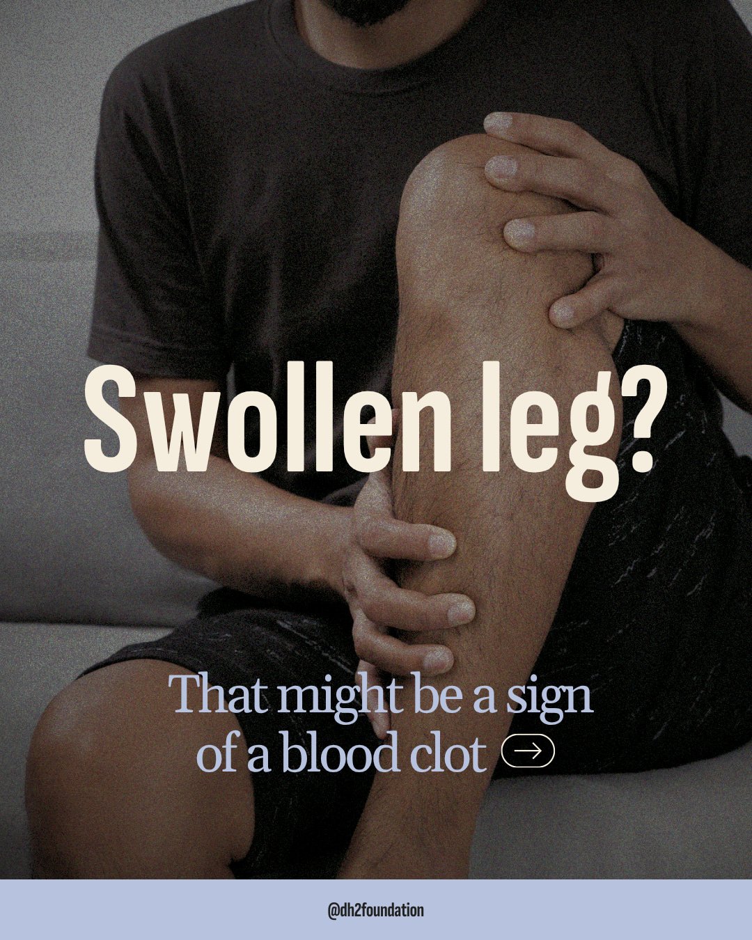 A swollen leg might be a muscle cramp. It might be nothing. But it also might be a blood clot and it's not worth waiting around to find out. DVT can turn deadly if left untreated. Don't ignore the signs of a blood clot! 

Share this with someone you 