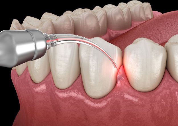Laser Periodontal Therapy in Oregon