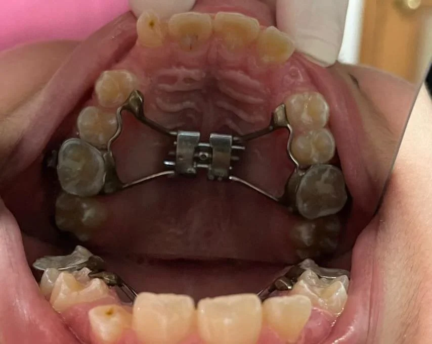 Vista interior de una boca con aparato ortodóntico en los dientes superiores y molar de color gris