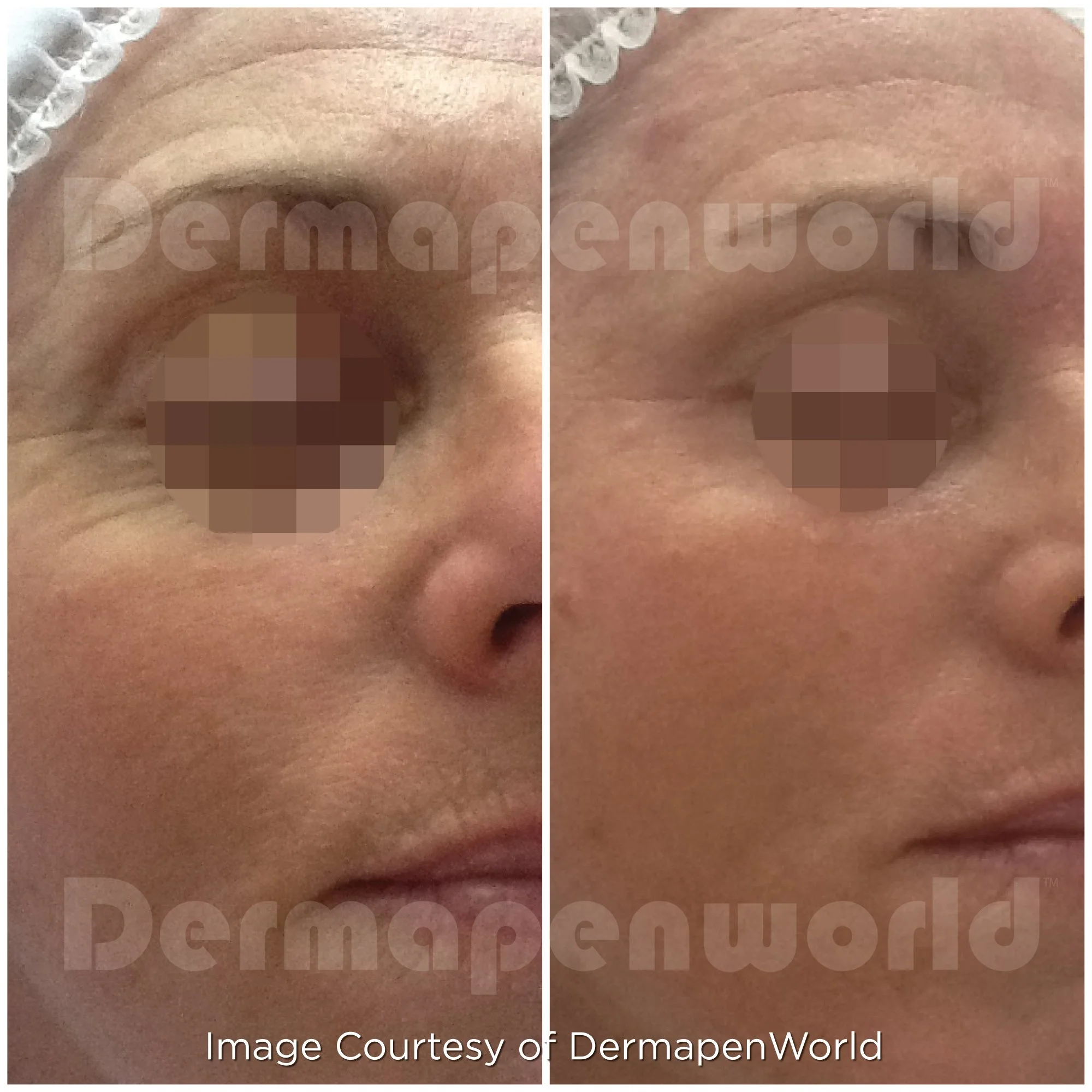 Before and after microneedling treatment showing smoother skin texture and fine lines in aging female