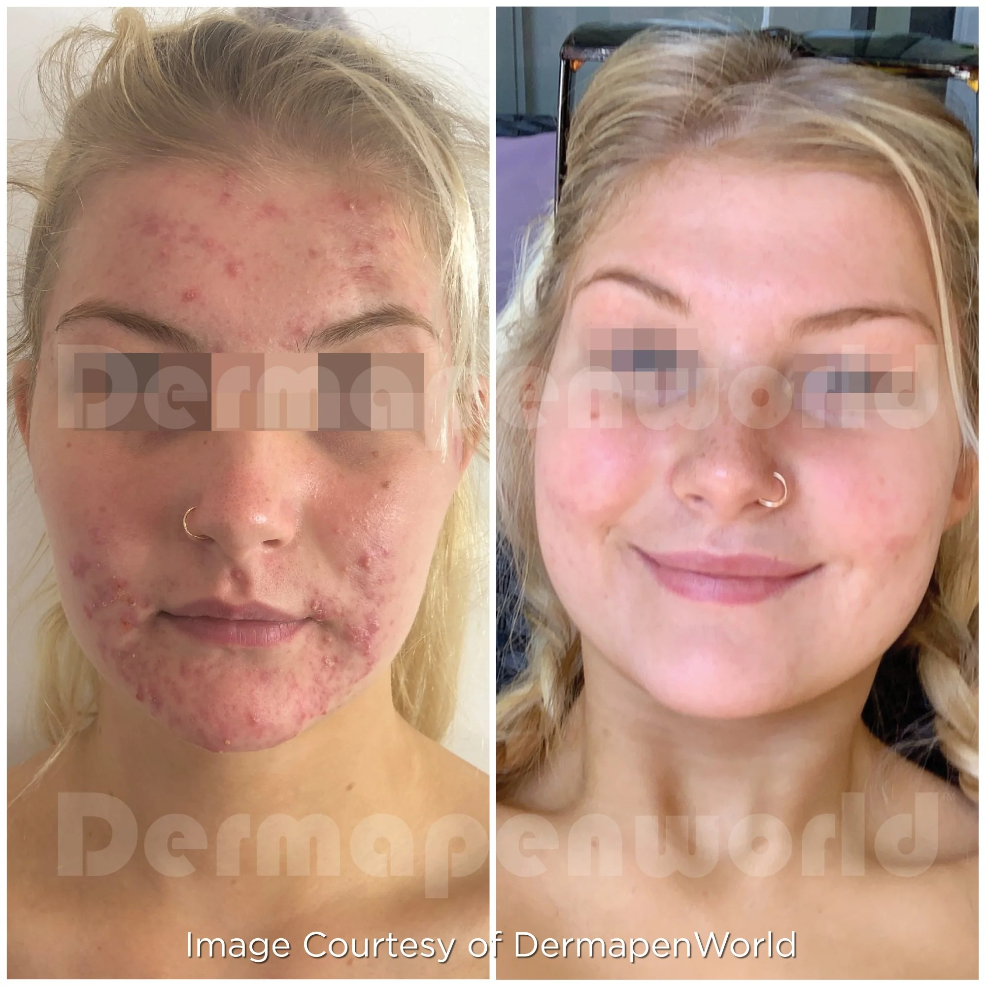 Before and after microneedling treatment showing improvement in acne-prone skin