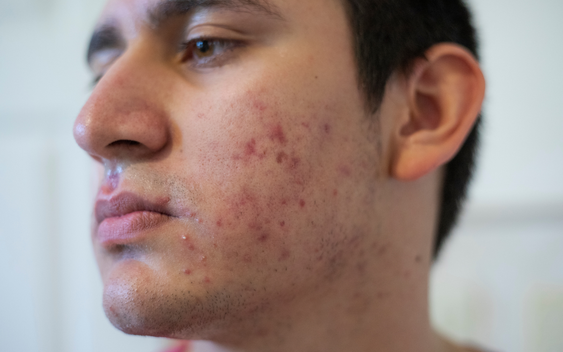 Close-up of a young man's face showing acne and skin redness.