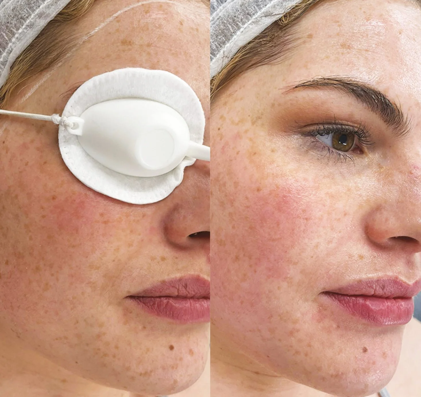 Comparison of a woman's face before and after skincare, with the left side showing her wearing a nasal oxygen tube and the right side showing clear, improved skin.