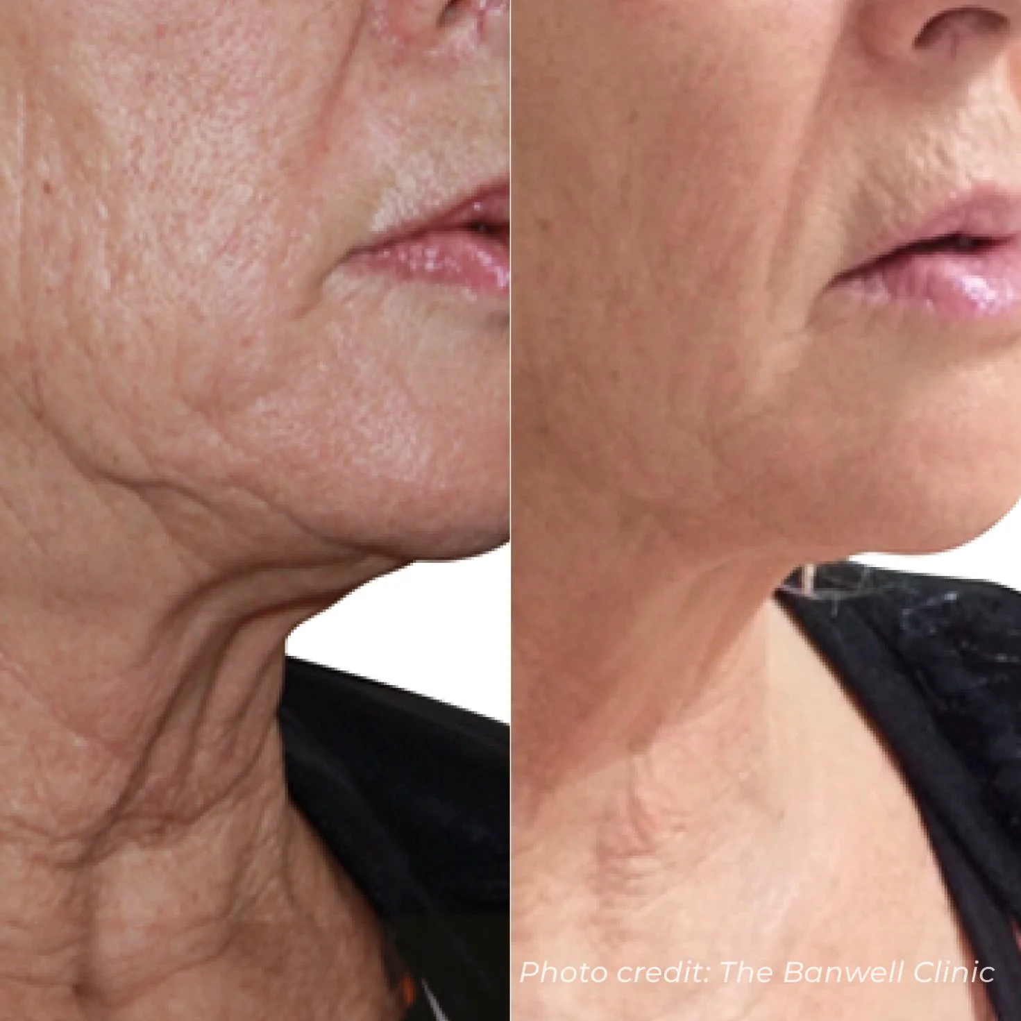 Comparison of a woman's face before and after skincare treatment, showing reduced wrinkles and improved skin texture.
