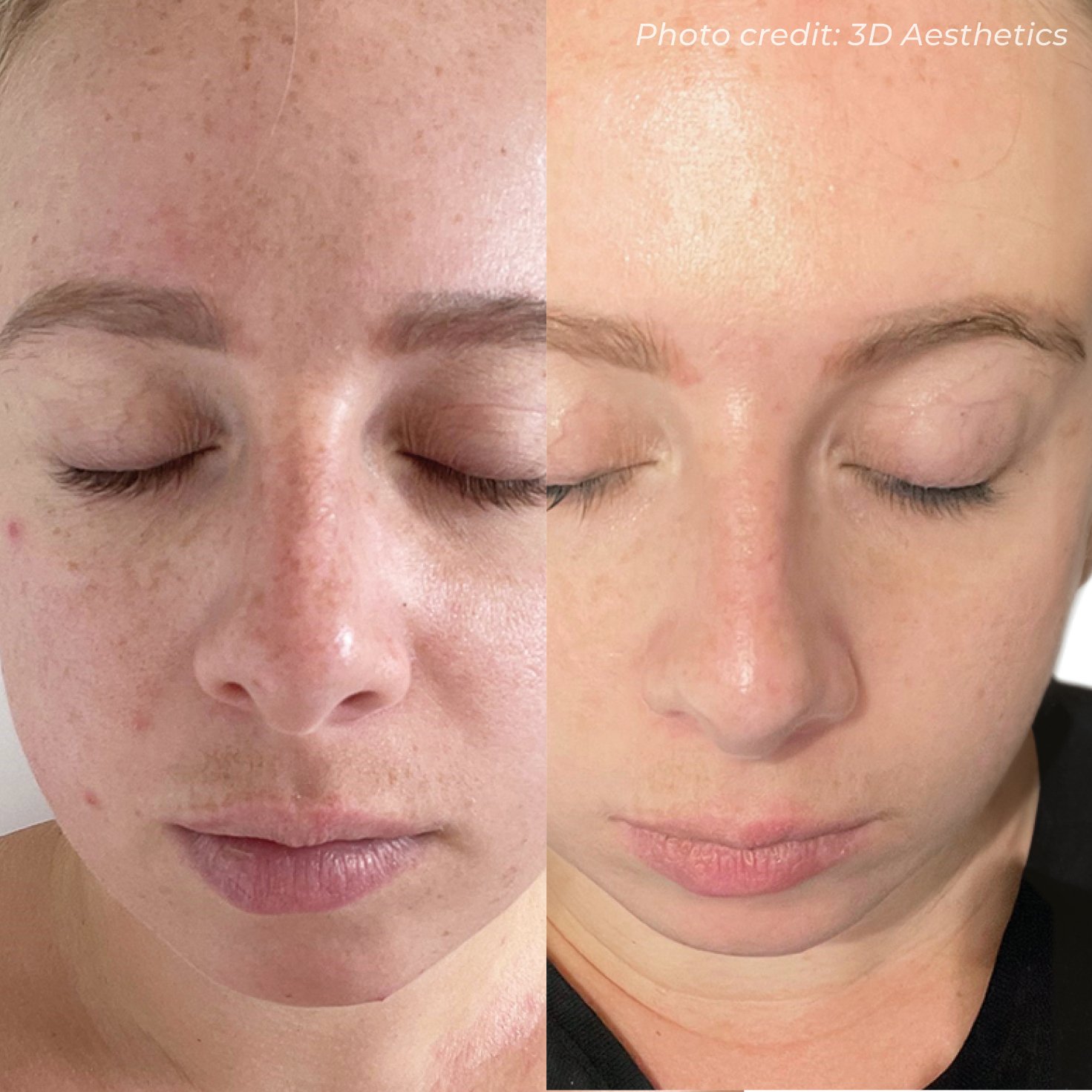Close-up of a woman's face before and after skincare treatment, showing reduced redness, clearer skin, and minimized pores.