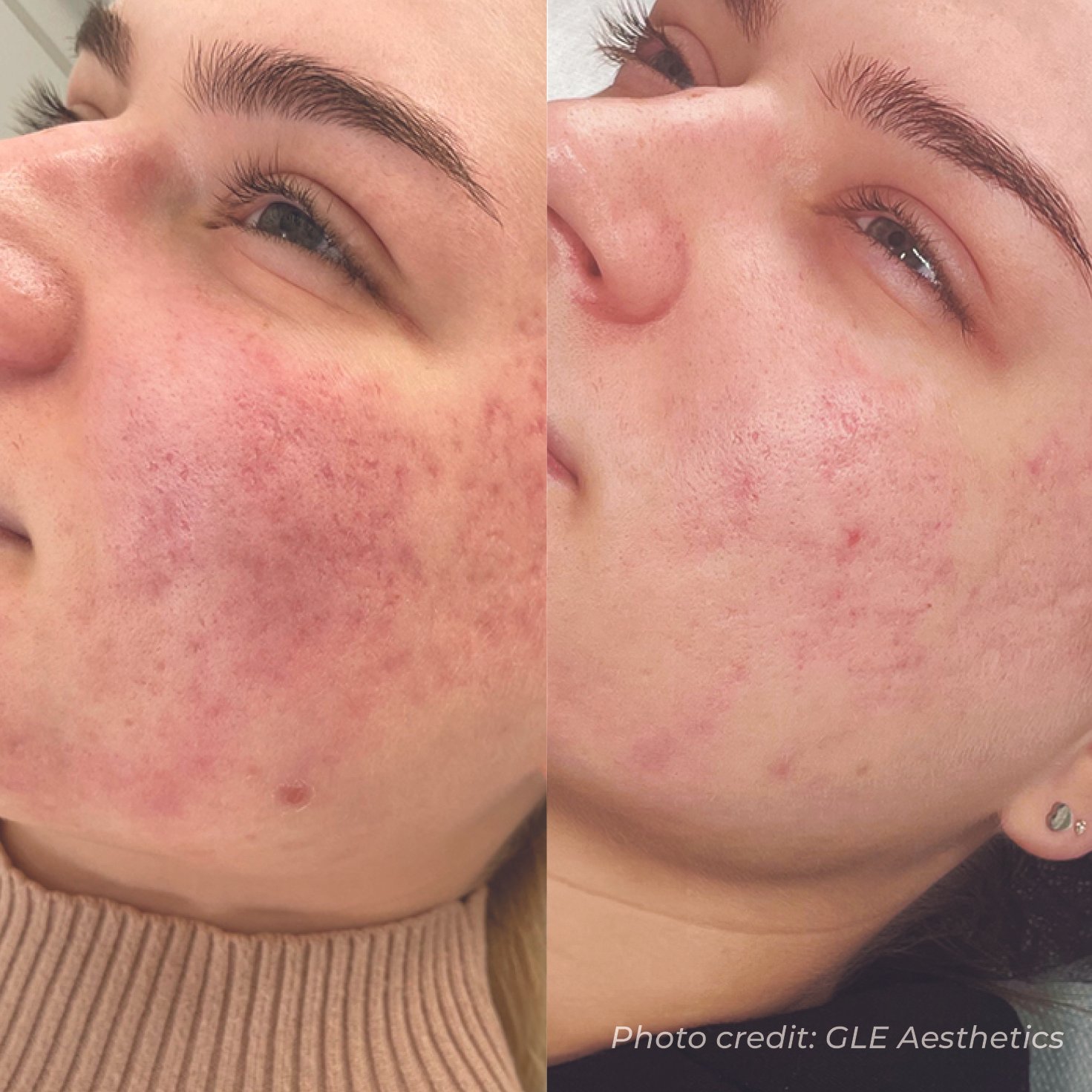 Comparison of a person's face showing improvement in skin condition, highlighting reduction in redness and acne scars after treatment.