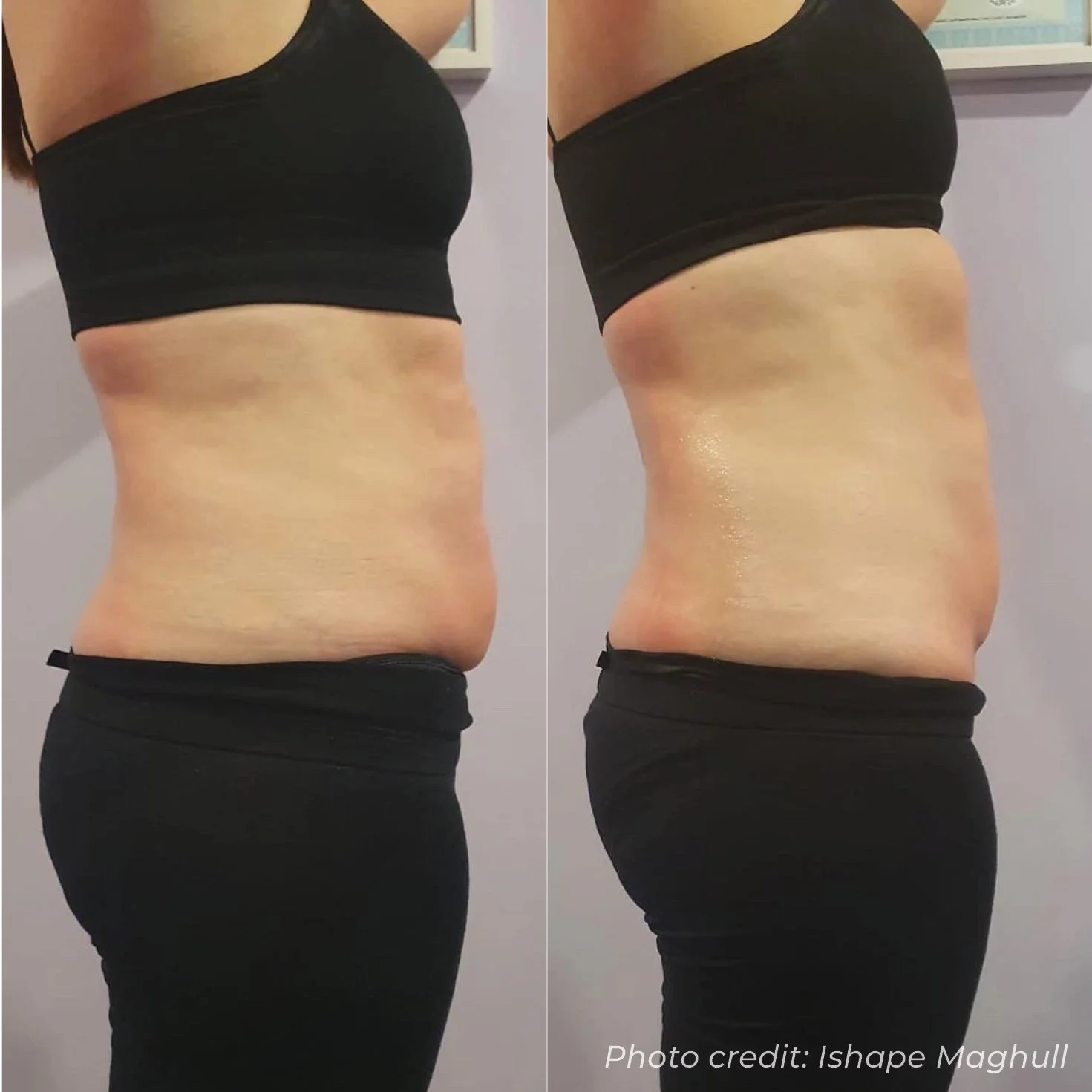 Comparison of a woman's midsection before and after a fitness or diet change, showing a reduction in abdominal fat with visible toned skin.