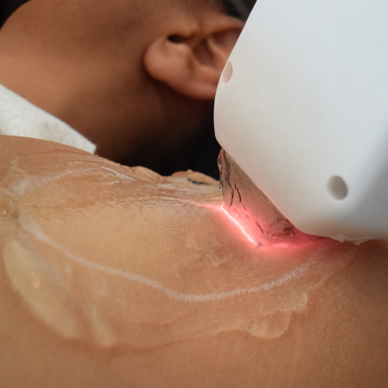 Undergoing a laser treatment on their skin. Laser Hair Removal in Ascot Medispa Berkshire