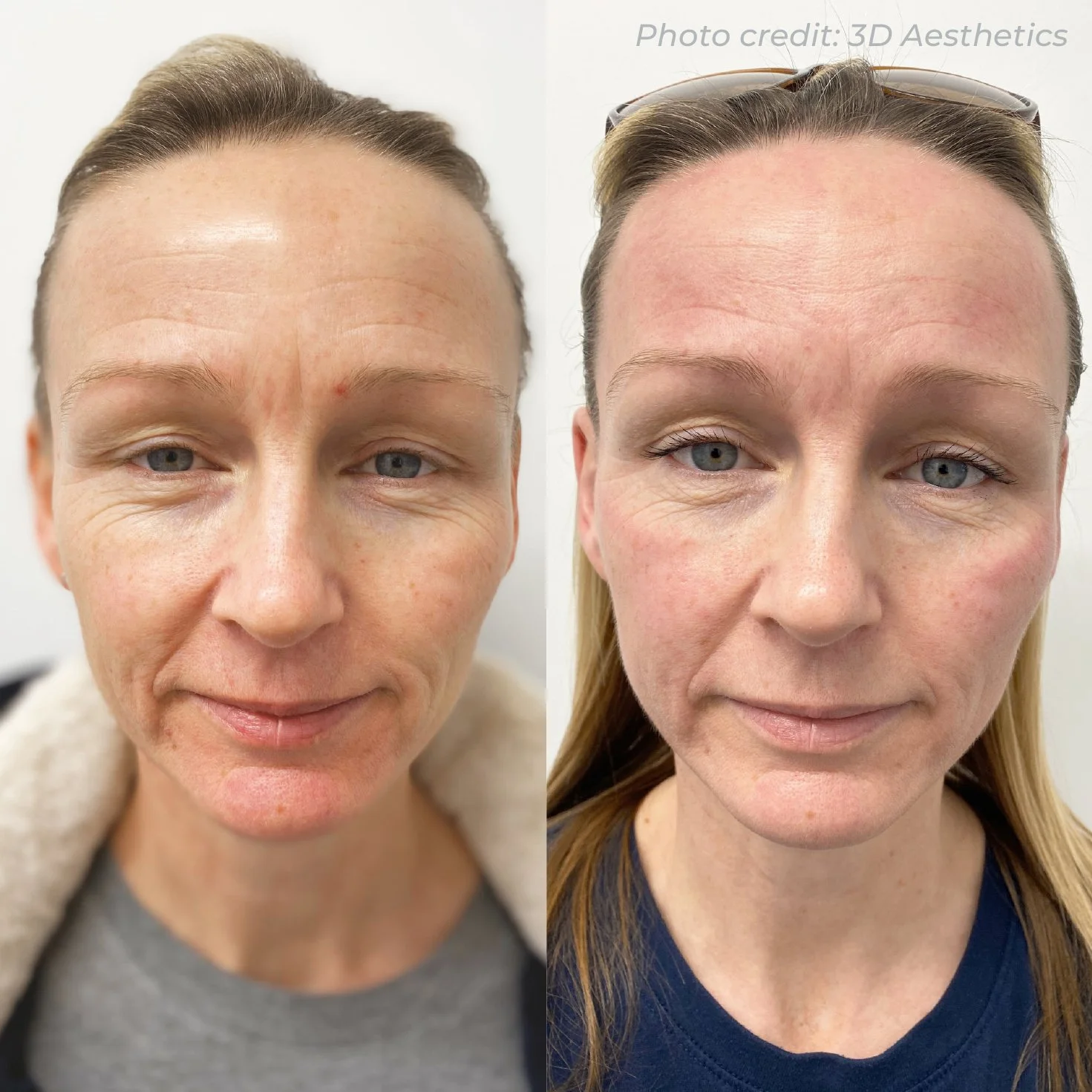 Side-by-side comparison of a woman before and after a cosmetic treatment, showing improved skin texture and reduced wrinkles.