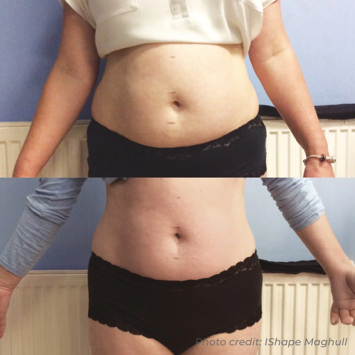 Comparison of a woman's abdomen before and after weight loss or fitness transformation, with the top image showing a larger belly and the bottom image showing a slimmer waist.