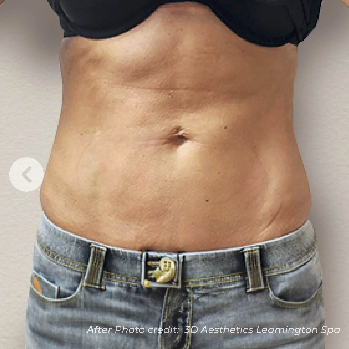 Close-up of a person’s toned abdomen wearing gray denim shorts with a Pac-Man belt buckle. The person has smooth skin with a few small beauty marks, and a small scar on the lower right side of the abdomen.
