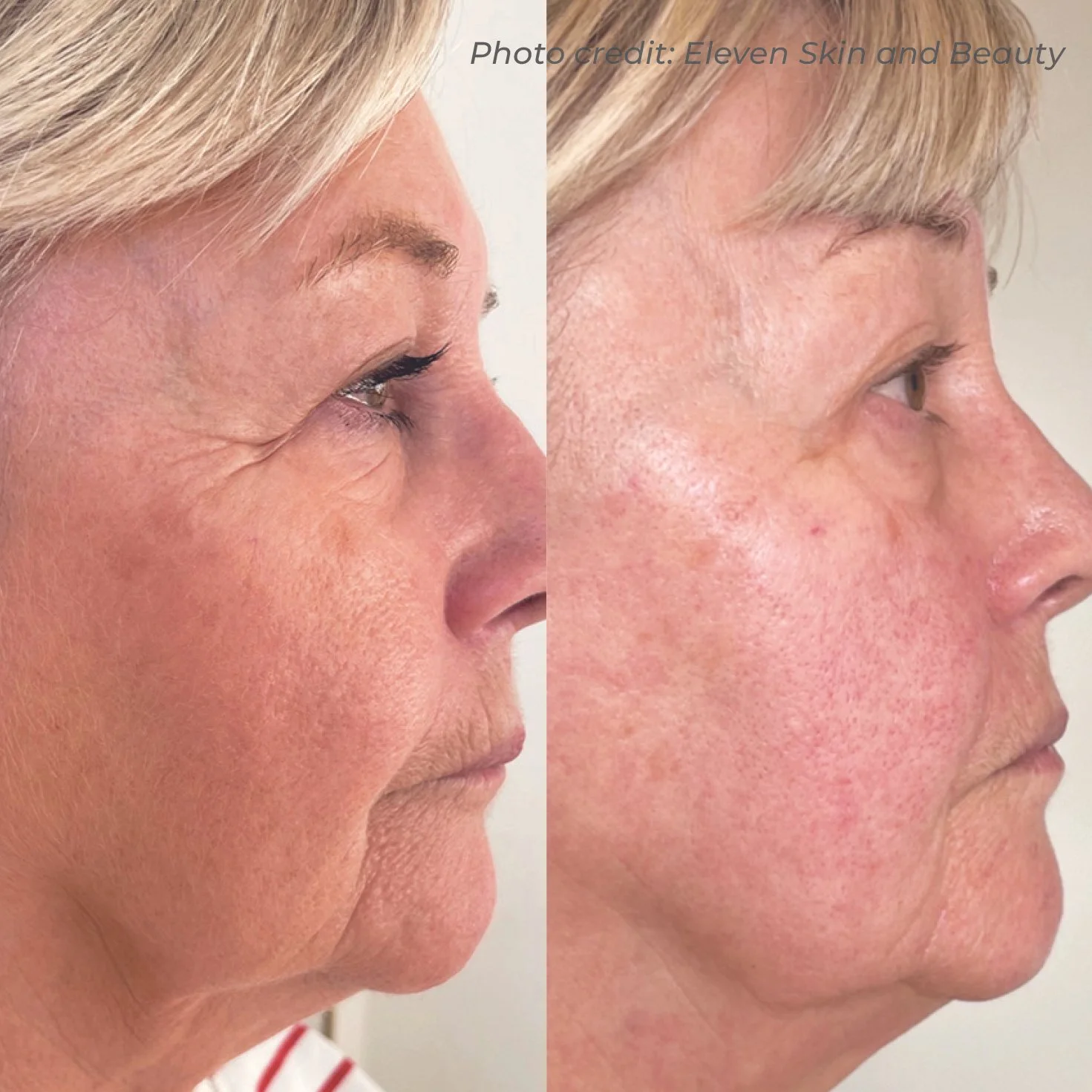 Side-by-side comparison of a woman's face showing skin improvement, with the left side before treatment and the right side after treatment.
