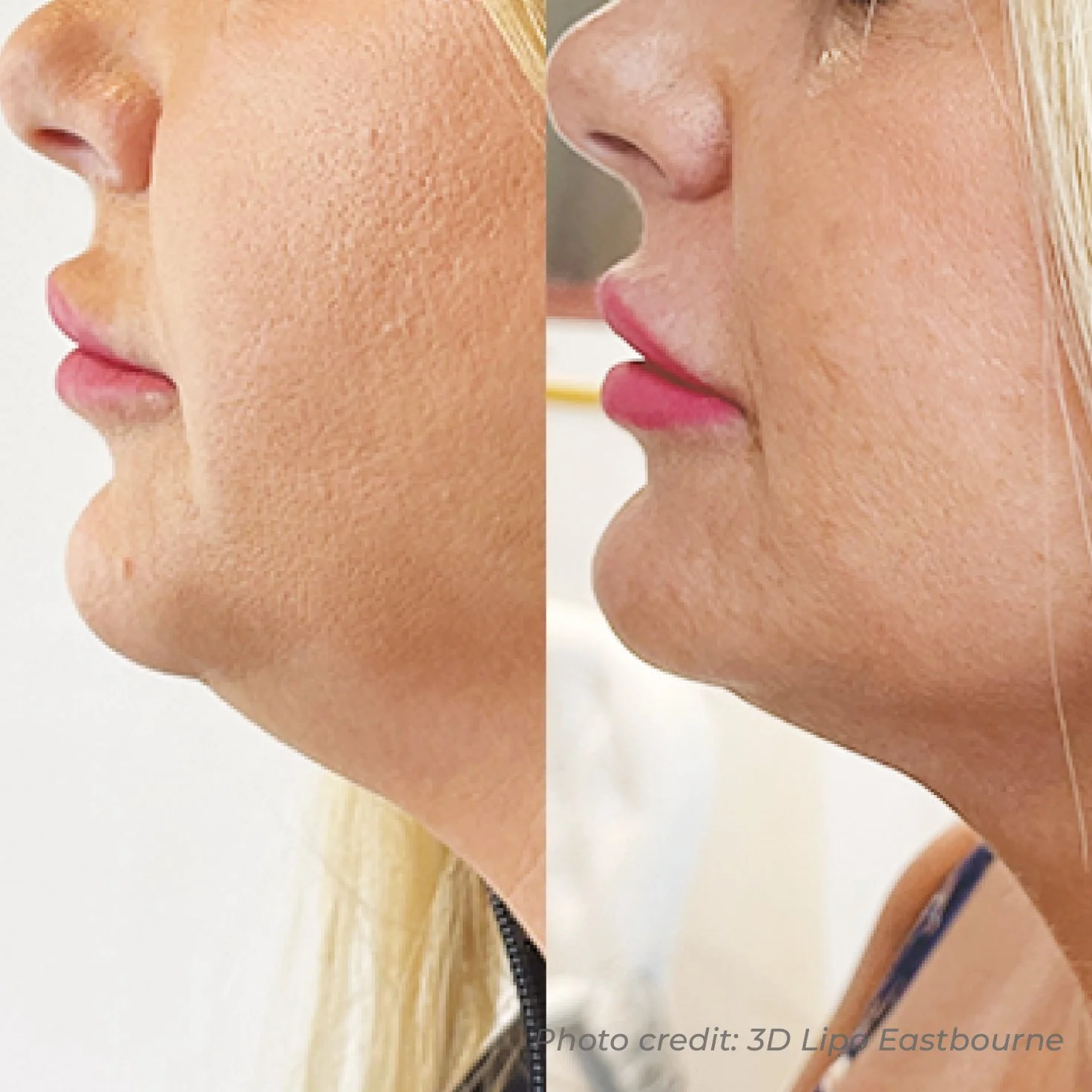Side-by-side comparison of a woman's face before and after a cosmetic procedure, showing improved skin texture and defined jawline.