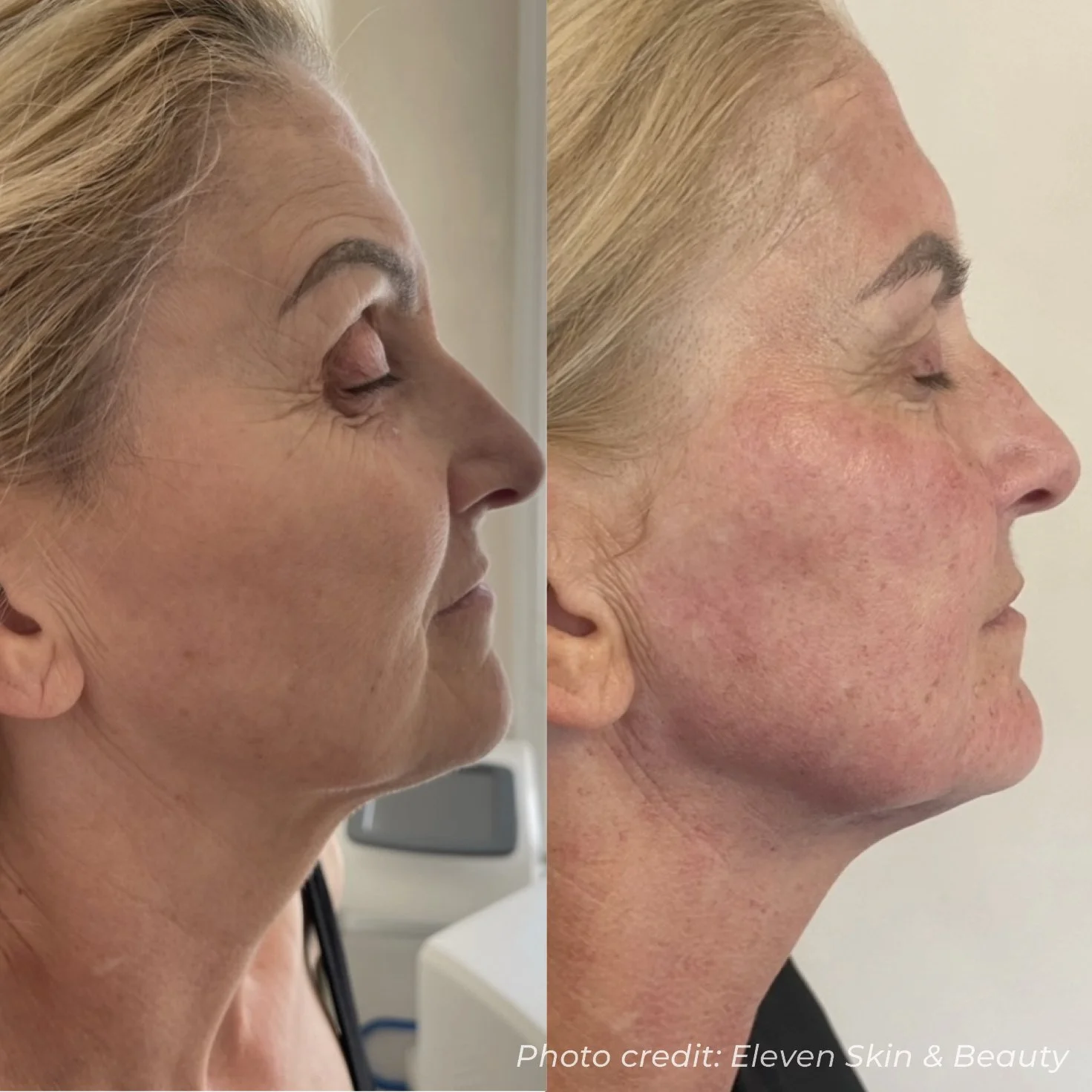 Side-by-side comparison of a woman's face showing before and after skin treatment, highlighting improved skin texture and reduction in wrinkles.