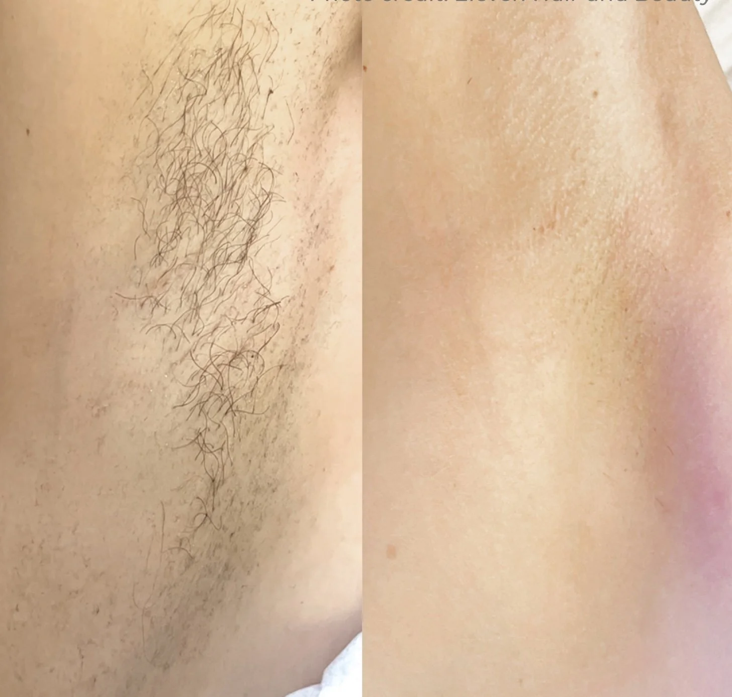 Comparison of skin with and without hair on the stomach.