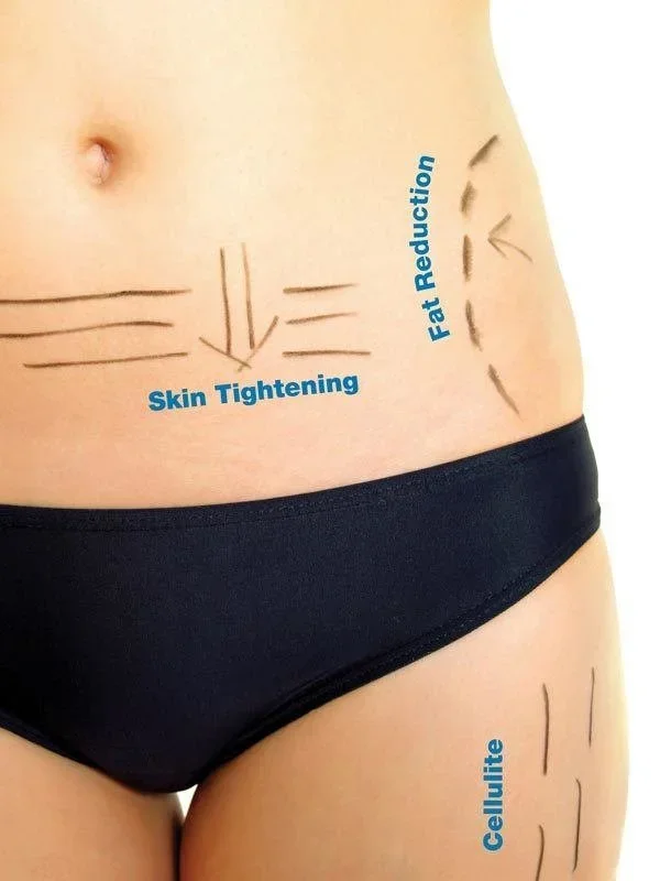 Annotated image of a woman's lower torso and upper thighs showing skin tightening, fat reduction, and cellulite treatment areas with marked lines and labels.