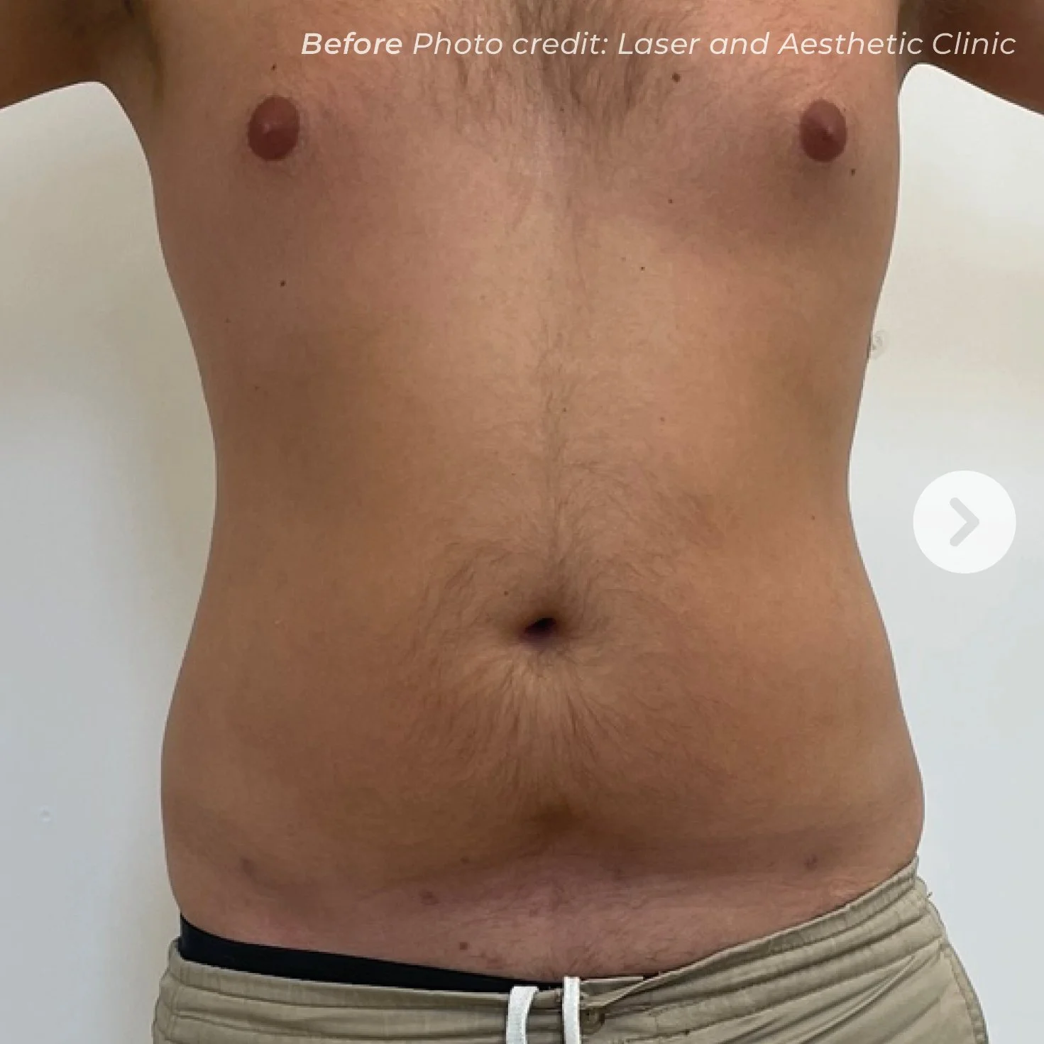 Close-up of a person's bare torso, showing chest, abdomen, and part of the waist, with a light skin tone and moderate hair growth.