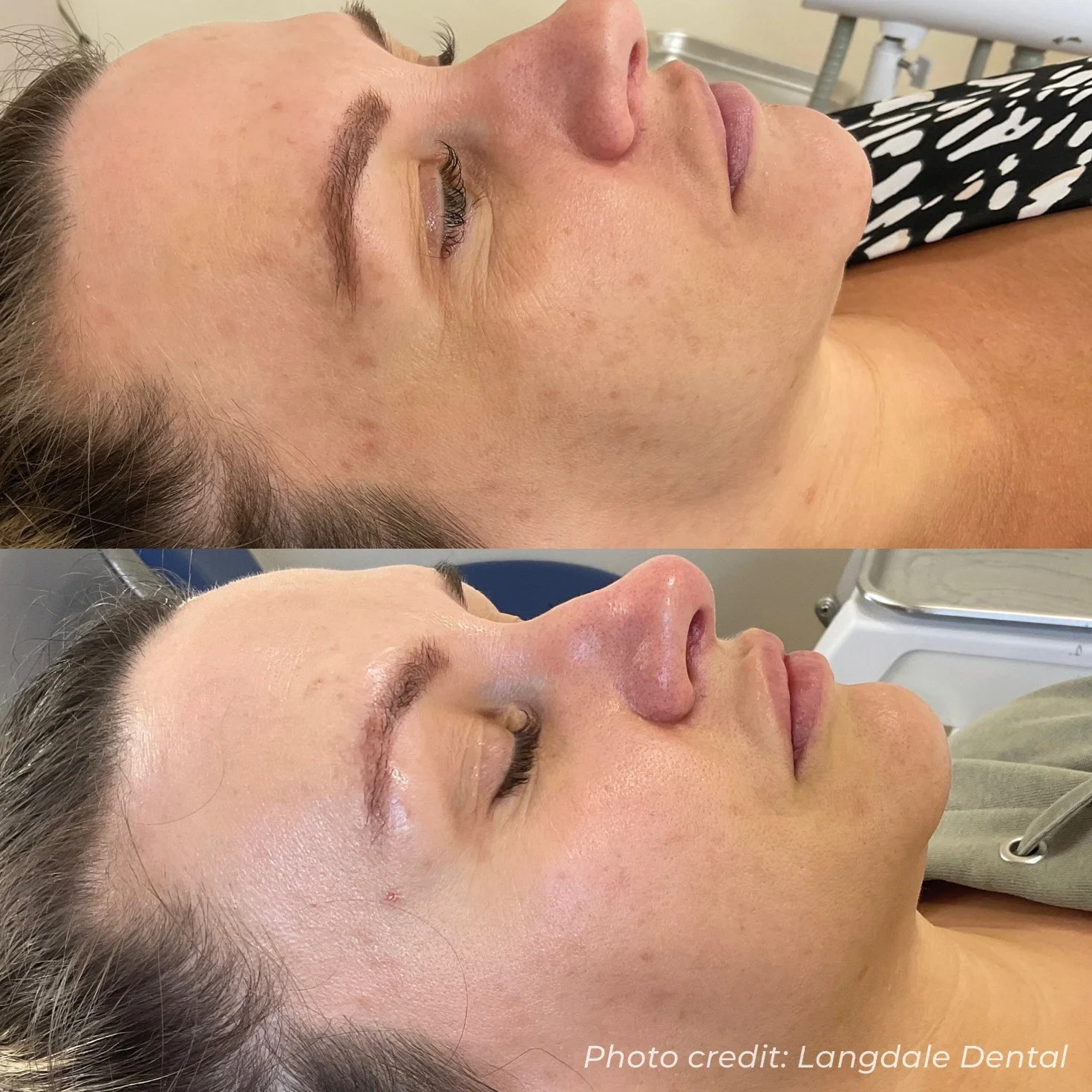 Side-by-side images of a woman before and after a dental or facial treatment, showing improvements in skin texture and appearance.