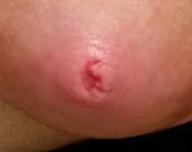 Cracked nipples during breastfeeding