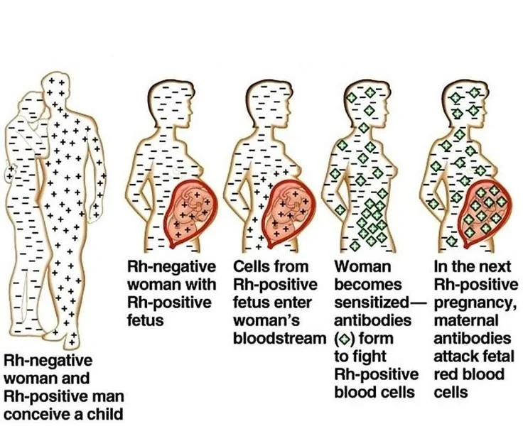 Illustration explaining RhD blood-group incompatibility