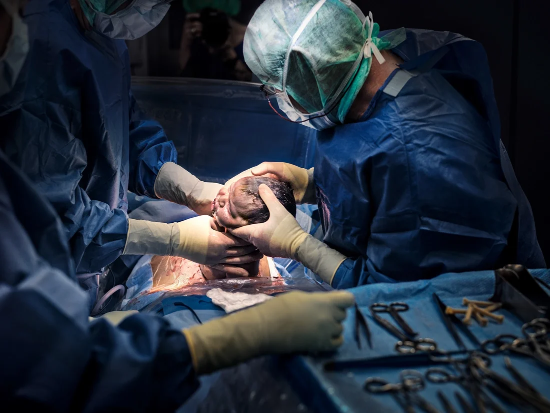 Cesarean Section Advanced