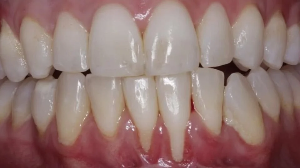 Example of Gum Recession