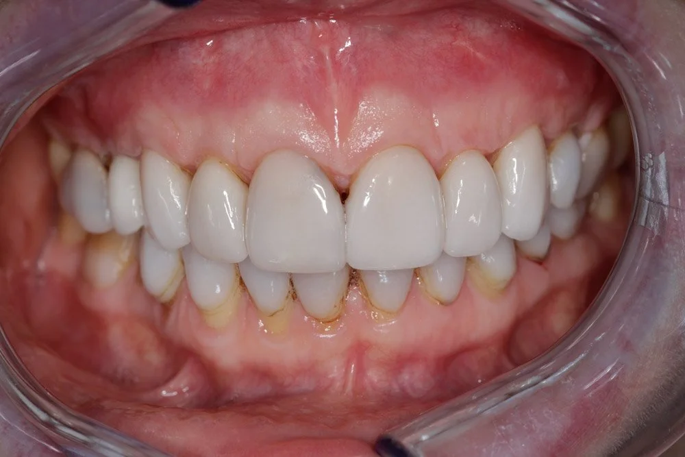 vaneer-gum-graft-3-dr-froum.jpg