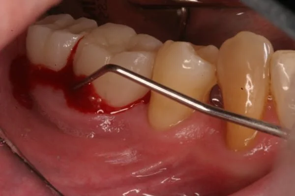 Bleeding Around a Dental Implant? What NYC Patients Should Do Next