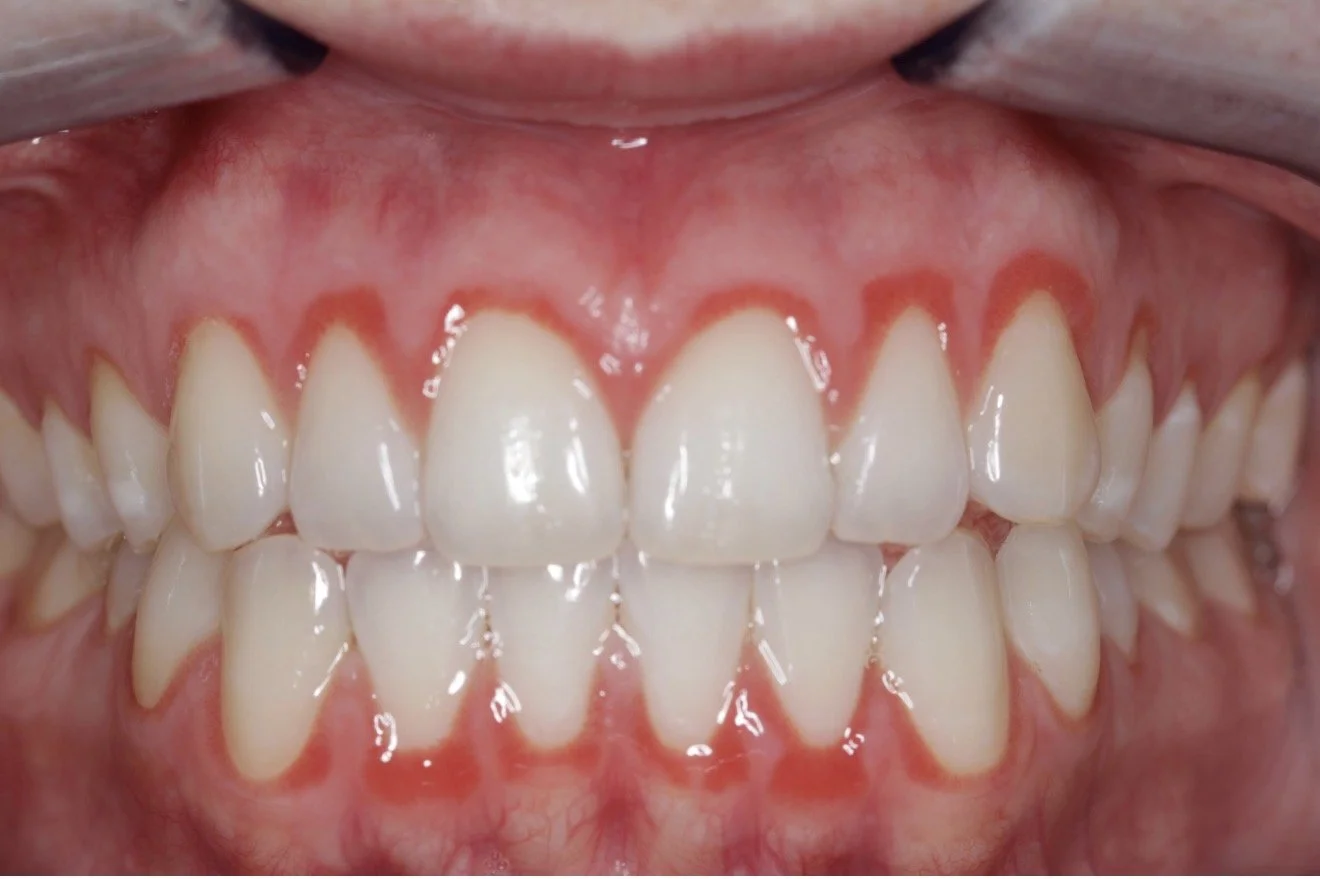 Inflamed, bleeding gums example: Can reflect systemic health issues