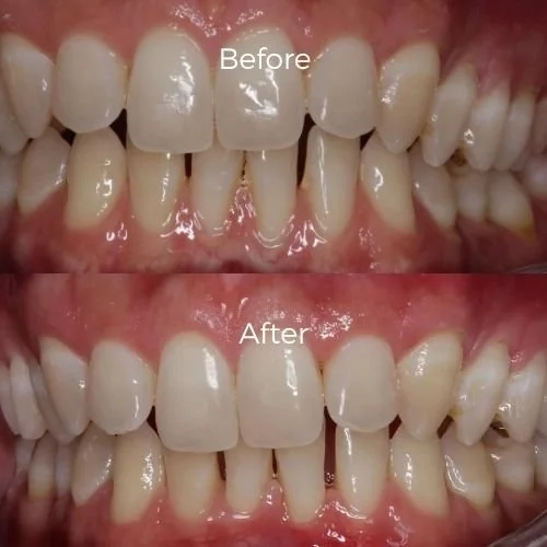 results after bone grafting with dr scott froum 