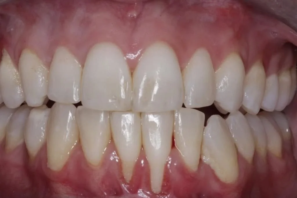 Before a gum grafting procedure with the best periodontist in NYC