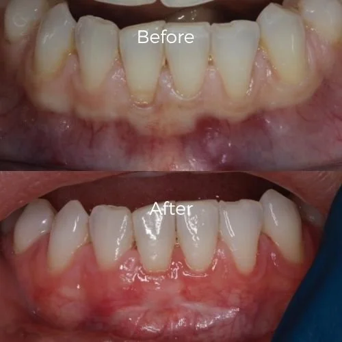graft for gum recession​ before and after 9
