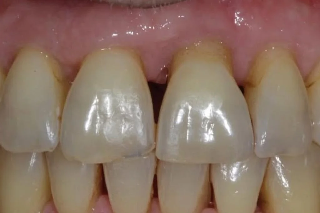 After Saving Teeth Treatment at Dr. Scott Froum's periodontist practice.